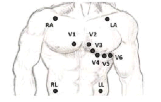 EKG: Chest wall lead according to Wilson